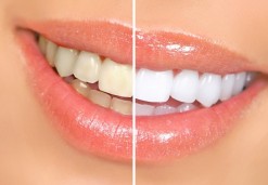 Teeth whitening - Osovnikar Dentists OZ 95'