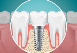 Implantology - implants - Osovnikar Dentists OZ 95'