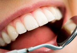 Parodontalno zdravljenje - Osovnikar zobozdravniki OZ 95'