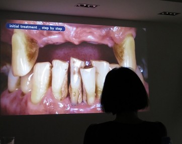 Implantati zobni vsadki predavanje 3 1