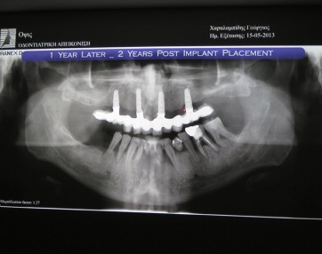 Implantati zobni vsadki predavanje 4 1