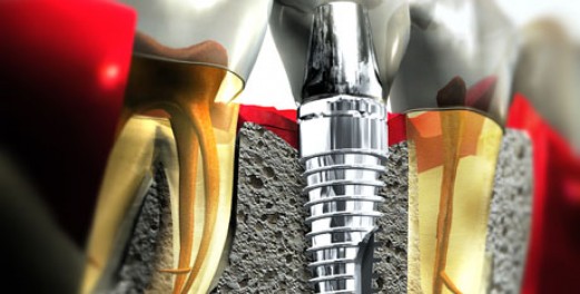Oral care around bridges and implants (dental implants)