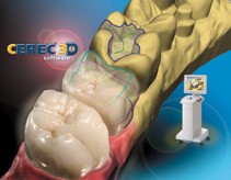 Nadaljevalno izobraževanje -  CEREC 3D protetika (CAD/CAM tehnologija)